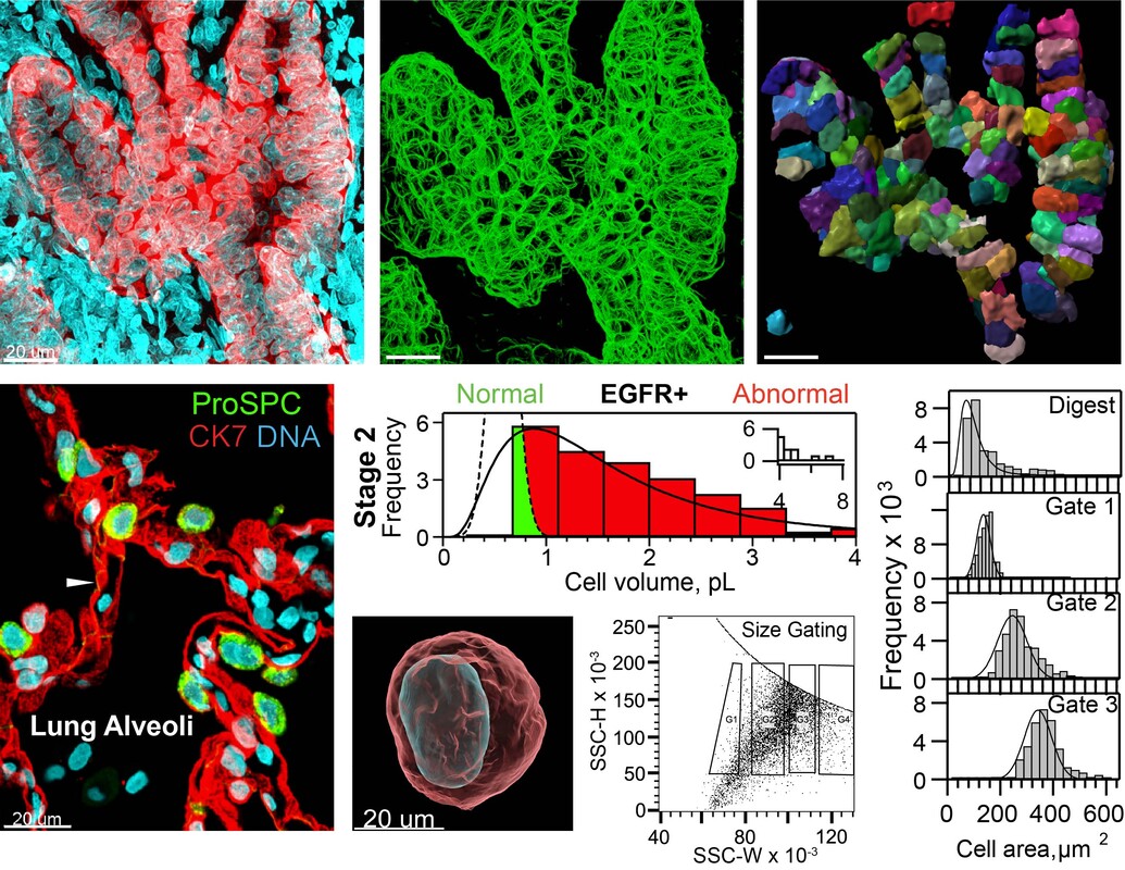 Epithelial Cell Size Dysregulation In Human Lung Adenocarcinoma